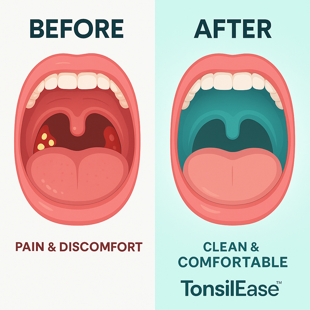 TonsilEase™ - Tonsil Stone Removal Kit